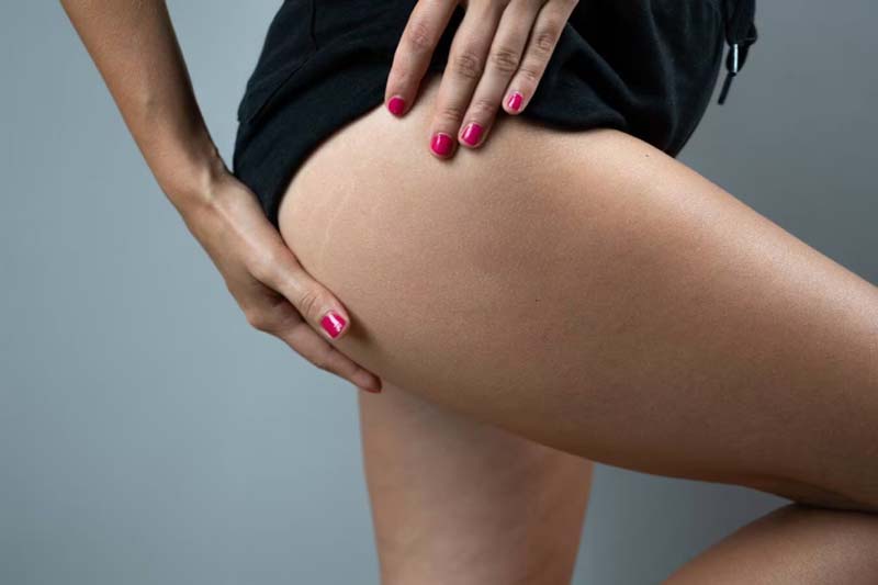 دلایل تجمع چربی در ناحیه باسن چیست؟